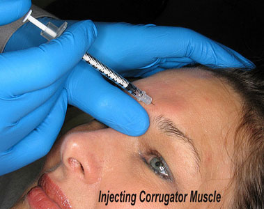 Injecting the Corrugator Muscle with 31ga Needle. 