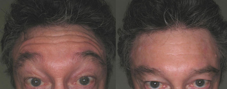 Before and After Forehead Botox Results!