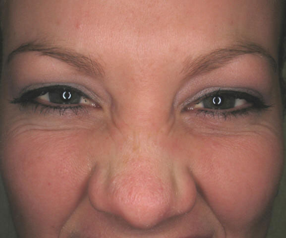 After Botox Treatment for Frown Lines!